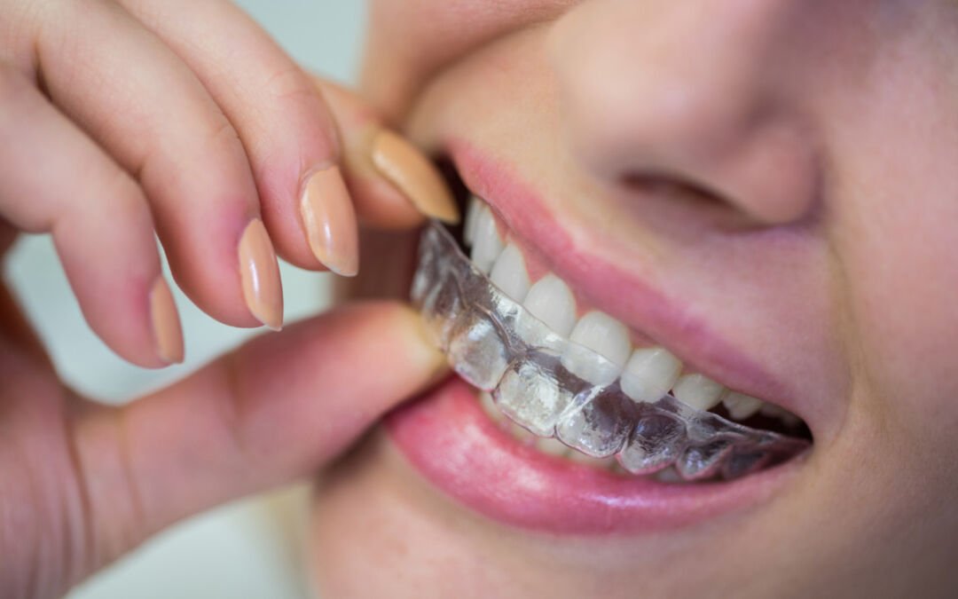 You Should be Aware of the Tips and Care of Invisalign