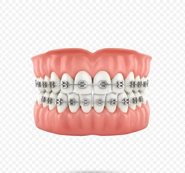 Can Fixing a Deep Overbite Cure Chronic Jaw Pain and Headaches?